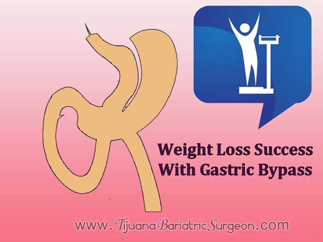 Gastric bypass in Tijuana - Mexico