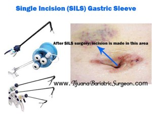 SIngle Incision SILS Gastric Sleeve