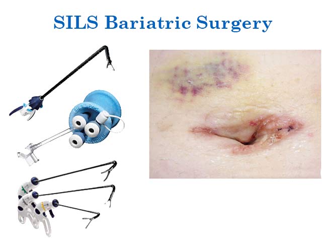 Single Incision Laparoscopic Bariatric Surgery (SILS)