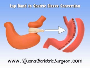 Lap Band to Gastric Sleeve Revision - Tijuana