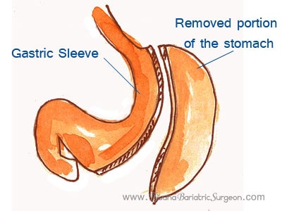 Gastric Sleeve Surgery - Mexico